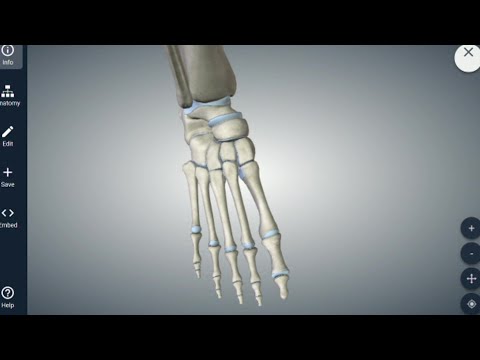 Multiple Metatarsal Fracture