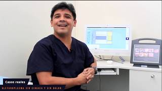 Blefaroplasma con Plasmage