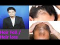 Hair Fall Or Hair Loss Treatment Risk Factor Symptoms Casuse Homeopathymedicine Treatment Tamil