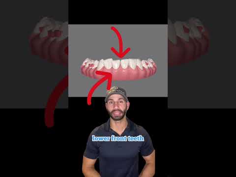 How I plan to fix this patient’s deep bite with Invisalign.