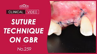 Download lagu Suture technique on GBR - [Dr. Kim Jaeyoon] mp3