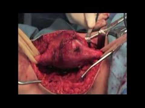 Envelope Schwannoma Of The Pripheral Sciatic Nerve