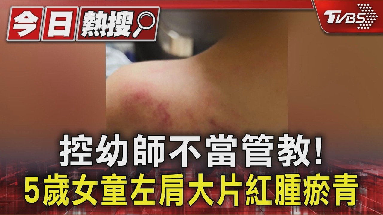 影音/控幼師不當管教! 5歲女童左肩紅腫瘀青 園方:該師已離職