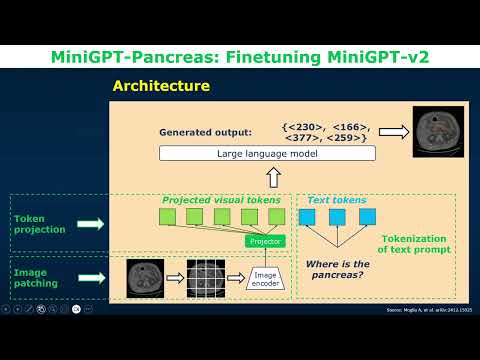 578 MiniGPT-Pankreas zur Diagnose von Bauchspeicheldrüsenkrebs