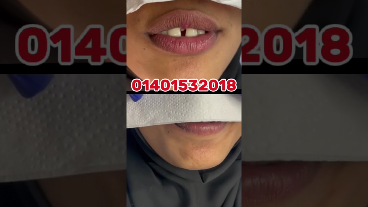 দাঁতের ফাঁকা সমস্যার সমাধান। - ভিডিও পর্যালোচনা
