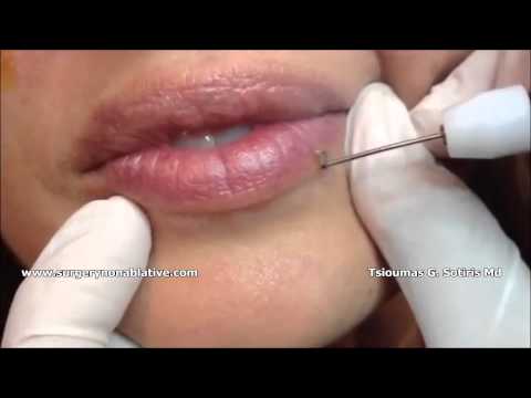 papilloma egy fán intraductalis papilloma aafp