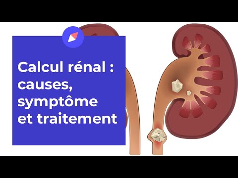 Comment savoir si j'ai des calculs rénaux