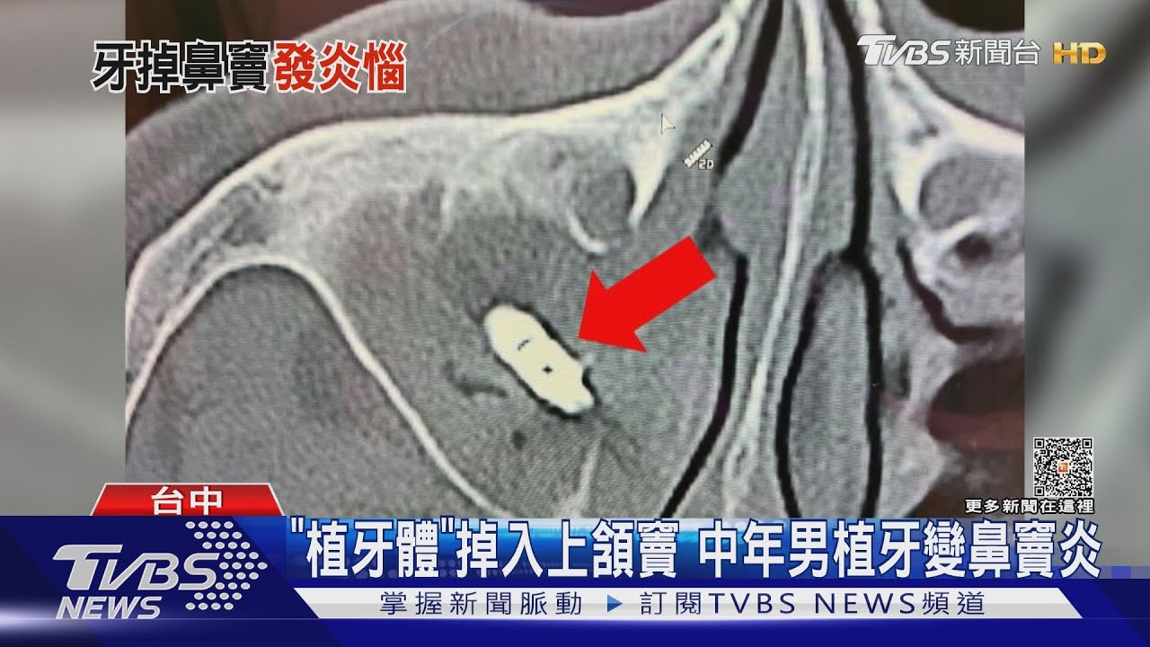 「植牙體」掉入上頷竇 中年男植牙變鼻竇炎