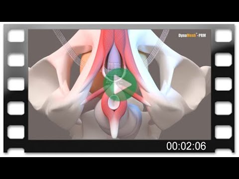 DynaMesh®-PRM visible - Animation: Surgical Treatment of Male Stress Urinary Incontinence
