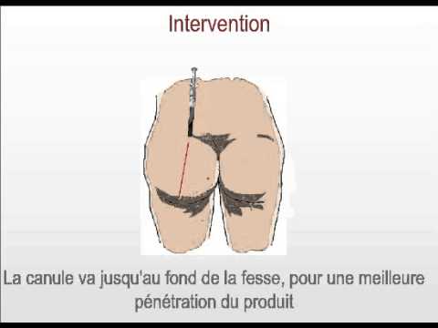 comment augmenter le volume de ses cuisses