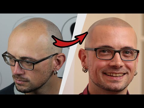 Video 1 Haarpigmentierung | Modern Hair Loss Solution