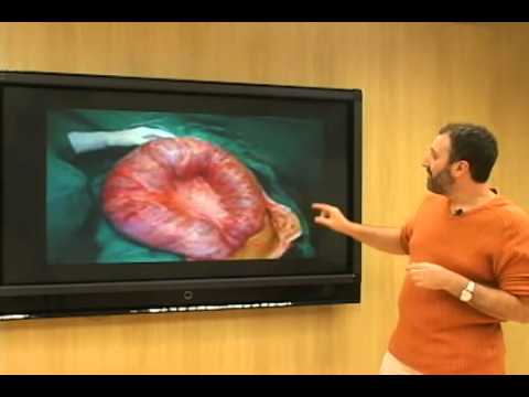 Vorbereitungen der Prostata in Thailand Prostatitis Schmerzen und Bein