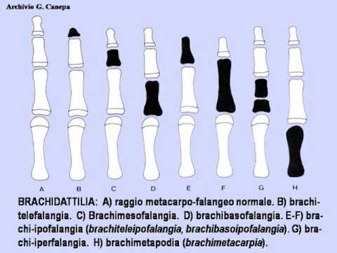 Osteocondrosi lombare gonfiore delle gambe Collari con osteocondrosi cervicale