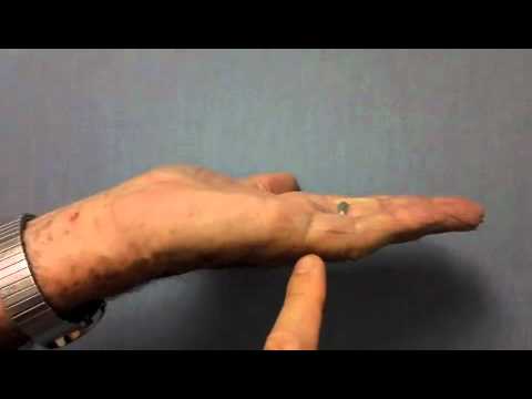 , title : 'Treatment of Dupuytren's Contracture with Xiaflex Video #3 (Dr. Kenty Sian)'