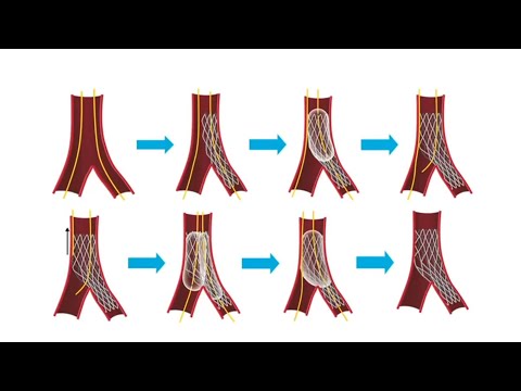 Case based step by step culotte technique in a bifurcation - Round Table Webinar