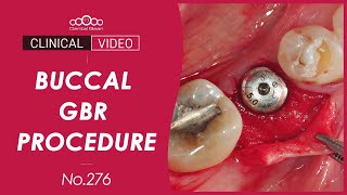 Download lagu Simple buccal GBR with membrane punch [Dr. Kim Jaeyoon] mp3