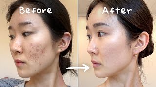 Download lagu 3 Secrets to Clearing Acne Without Medication (No Accutane / Tretinoin) mp3