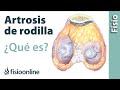 ¿Qué es la Artrosis de rodilla o desgaste de rodilla ...