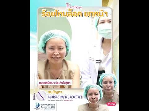 รีวิวหัตถการโปรแกรมร้อยไหมเทคนิค Spread Lock