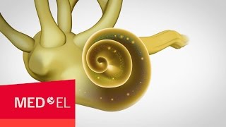 Sensorineural Hearing Loss Occurs in the Cochlea