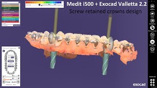 Medit i500 + Exocad Valletta 2.2  - Screw retained crowns design