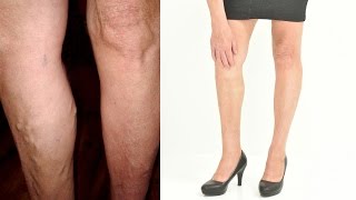 Removal of varicose veins - Jana