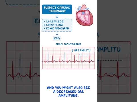 Diagnostics on Demand Cardiac tamponade
