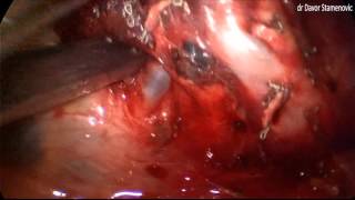 Uniportal Posterior Approach for VATS Anatomical Resection of Apical Segment of the Left Lower Lobe