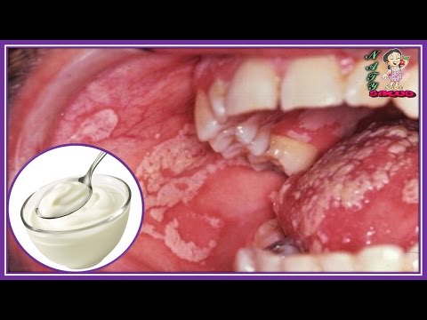 Por qué el hongo de las uñas en un pie Como por el vinagre sanar el hongo de las uñas las revocaciones