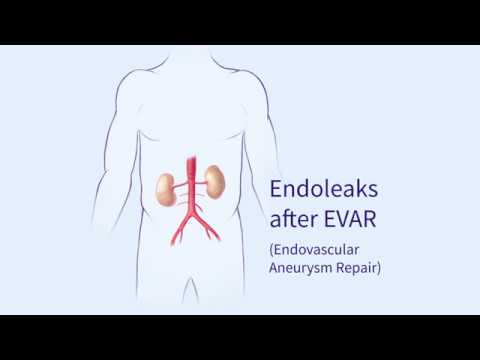 Endoleaks after Endovascular Repair of Thoracic Aortic Aneurysms (EVAR)