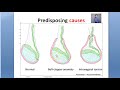 Surgery Torsion Testis Bell Clapper Deformity Deming Prehn Angeli Sign