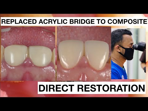 Changing Dental Bridge Acrylic to Direct Composite