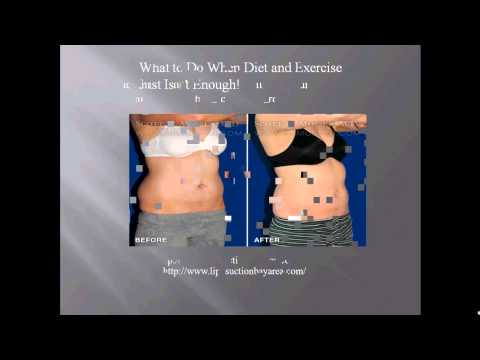 The Potential Medical Benefits of Liposuction