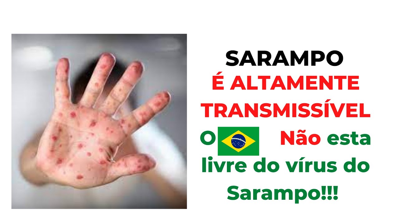 Aula Completa sobre SARAMPO: Quais os sintomas? Como se transmite?