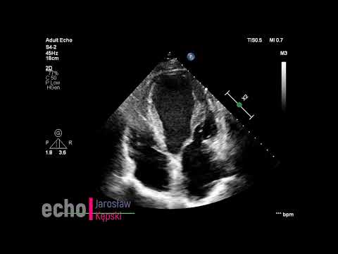 Silent myocardial infarction heart failure LVEF 27% Left bundle branch block, first echocardiography