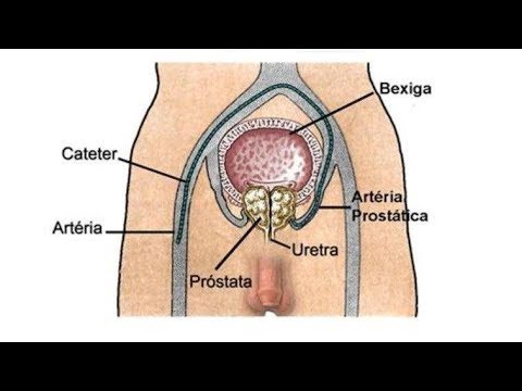 Embolizare prostata cluj