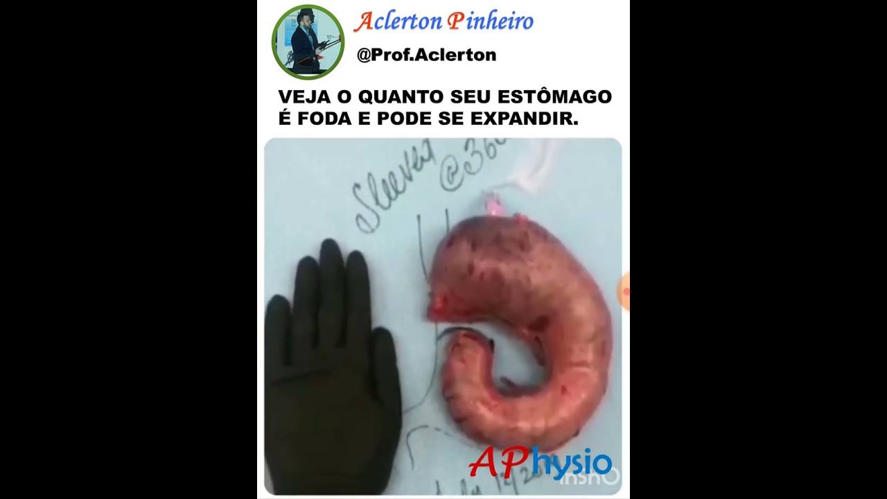 Veja o incrível tamanho que o estômago consegue chegar