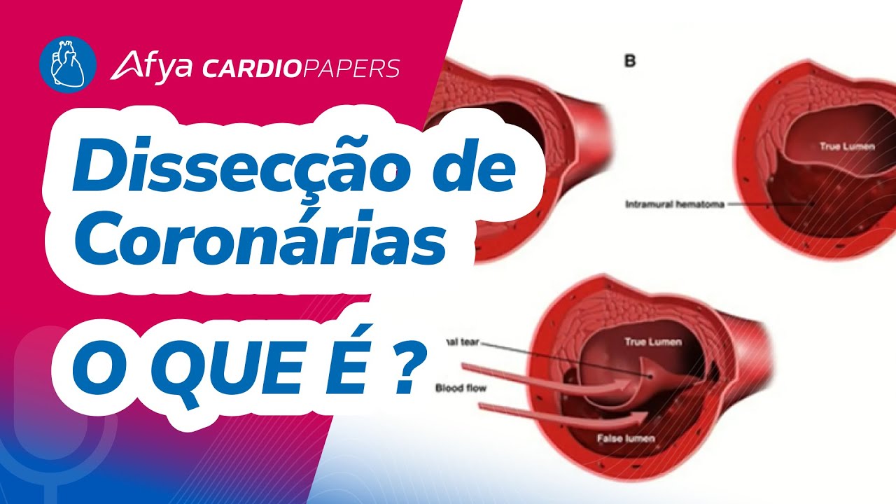 O que é dissecção de coronária?