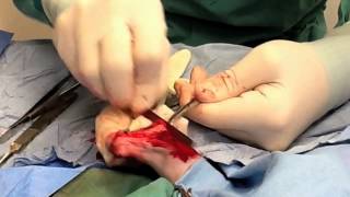 Tibial Fracture (Broken Leg: Cat)