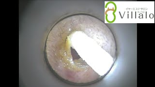 耳掃除動画vol.57「アメ耳さんの耳垢の輪」