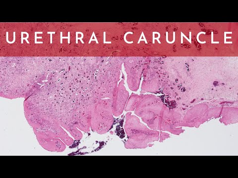 What is a Urethral Caruncle? - Pathology mini tutorial