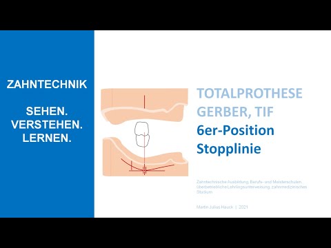Modellanalyse Totalprothese: 6er Position & Stopplinie