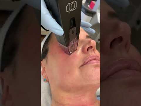 Skin care with Morpheus 8