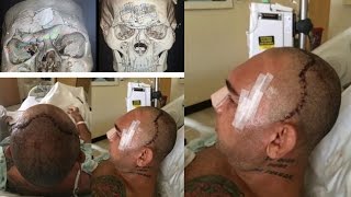'Cyborg' Santos UNDERGOES 7-HOUR SURGERY FOR SKULL FRACTURE INJURY vs Michael Page