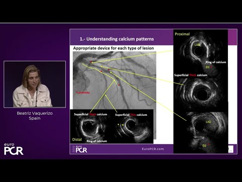 Low contrast complex PCI in a severely calcified lesion: the right tools and techniques EuroPCR 2022
