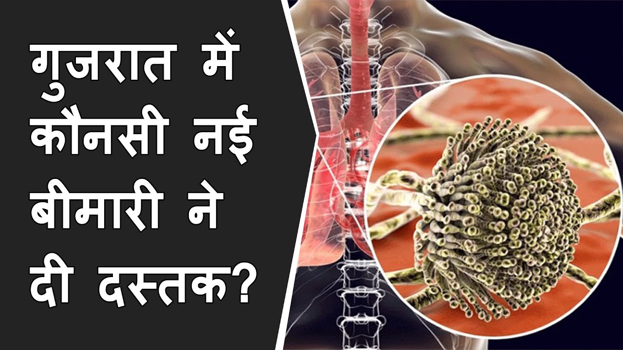 Aspergillosis Fungal Infection 100 case found in Rajkot Gujarat | aspergillus fungus medicine
