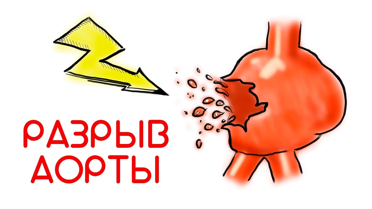 Разрыв аорты = смерть // Доктор Ху