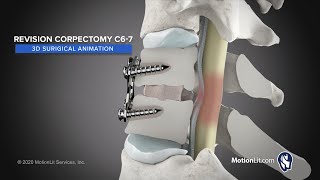 Download lagu 3D Surgery Animation Portrays Cervical Spine Revisions mp3 Download lagu 3D Surgery Animation Portrays Cervical Spine Revisions mp3