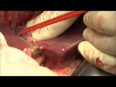 nonStick flush and maXium® – EHT in der Leberchirurgie