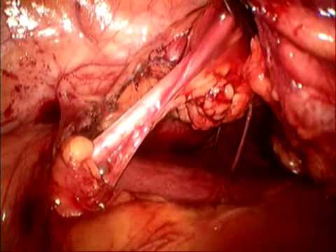 Donor Kidney Excision Via Vagina